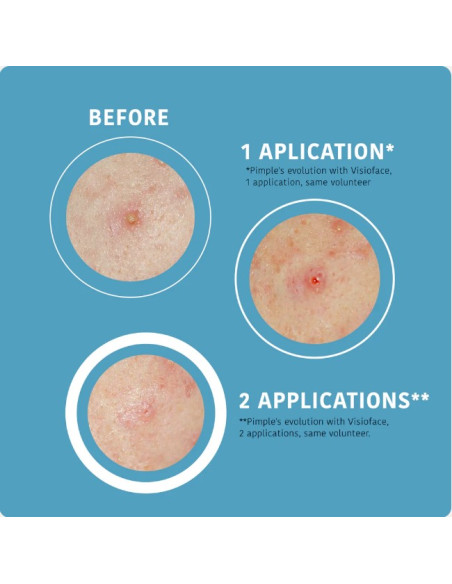 IROHA NATURE ACNE PRONE SOS akneplaastrid salitsüülhappe, teepuu ja Centella Asiatica'ga 18 tk.