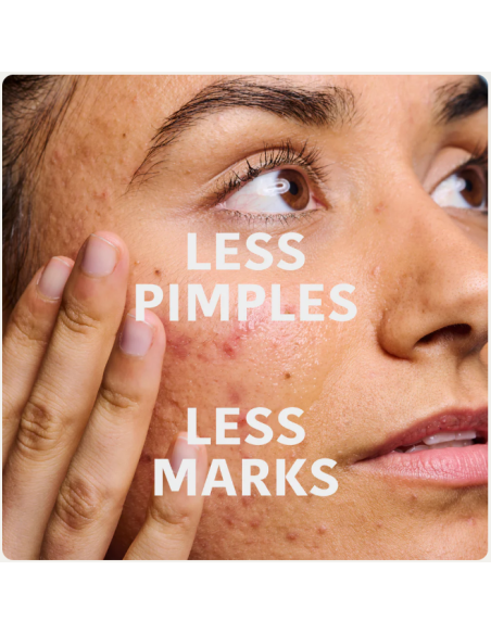 IROHA NATURE ACNE PRONE seerum salitsüülhappega aknearmide ennetamiseks ja silumiseks 30ml
