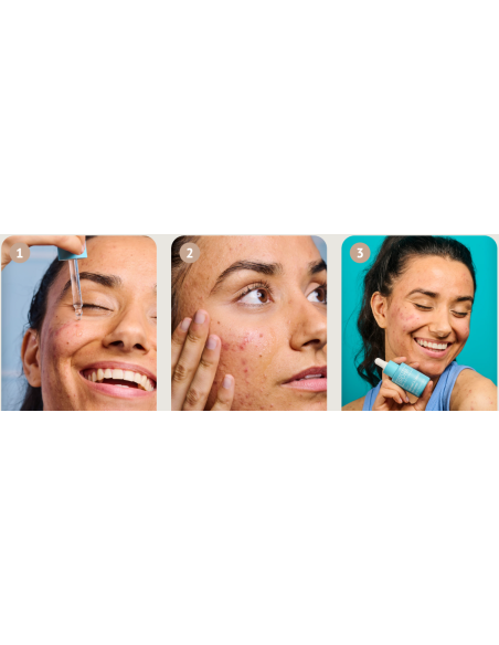 IROHA NATURE ACNE PRONE seerum salitsüülhappega aknearmide ennetamiseks ja silumiseks 30ml